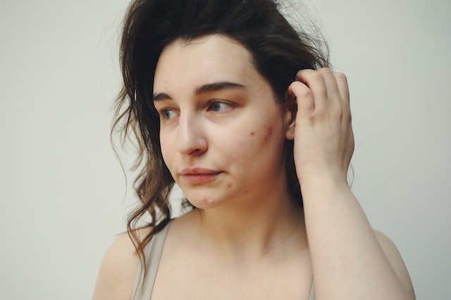 Portrait of a Woman With Acne on her face